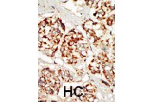 Formalin-fixed and paraffin-embedded human hepatocellular carcinoma tissue reacted with KSR1 polyclonal antibody  , which was peroxidase-conjugated to the secondary antibody, followed by DAB staining. (KSR1 anticorps  (N-Term))