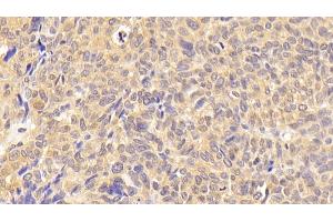 Detection of WNT7B in Human Ovarian cancer Tissue using Polyclonal Antibody to Wingless Type MMTV Integration Site Family, Member 7B (WNT7B)