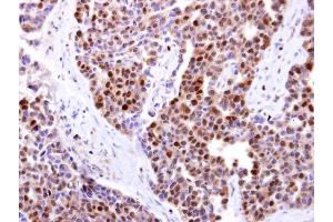IHC-P Image DCK antibody detects DCK protein at cytosol and nucleus on human lung carcinoma by immunohistochemical analysis.