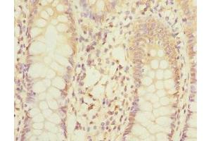 Immunohistochemistry of paraffin-embedded human colon cancer using ABIN7158982 at dilution of 1:100
