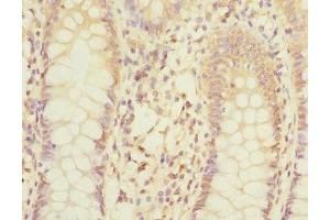 Immunohistochemistry of paraffin-embedded human colon cancer using ABIN7158982 at dilution of 1:100 (MPI anticorps  (AA 1-423))