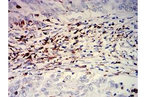 Immunohistochemical analysis of paraffin-embedded cervical cancer tissues using CD274 mouse mAb with DAB staining.
