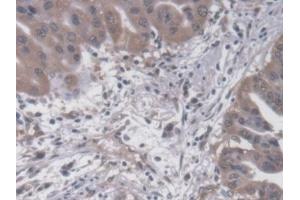 Detection of SYT1 in Human Liver cancer Tissue using Polyclonal Antibody to Synaptotagmin I (SYT1)