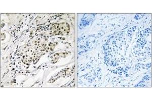 Immunohistochemistry analysis of paraffin-embedded human breast carcinoma, using CDYL2 Antibody. (CDYL2 anticorps  (AA 31-80))