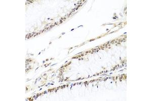 Immunohistochemistry of paraffin-embedded human colon carcinoma using HIRA antibody (ABIN6128018, ABIN6141776, ABIN6141778 and ABIN6224528) at dilution of 1:100 (40x lens). (HIRA anticorps  (AA 250-550))