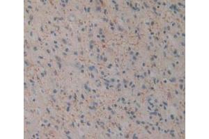 Detection of CD161 in Human Glioma Tissue using Polyclonal Antibody to Cluster Of Differentiation 161 (CD161)