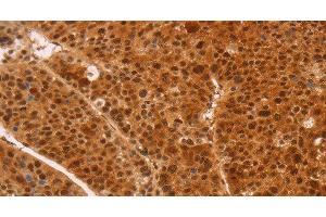 Immunohistochemistry of paraffin-embedded Human liver cancer tissue using HEXIM1 Polyclonal Antibody at dilution 1:65