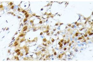 Immunohistochemistry of paraffin-embedded Human breast cancer using PRMT1 Polyclonal Antibody at dilution of 1:100 (40x lens). (PRMT1 anticorps)