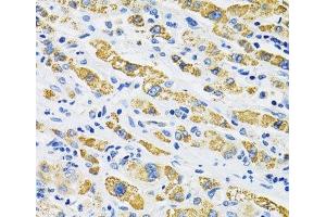 Immunohistochemistry of paraffin-embedded Human liver cancer using SLC16A4 Polyclonal Antibody at dilution of 1:100 (40x lens). (SLC16A4 anticorps)