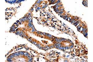 The image on the left is immunohistochemistry of paraffin-embedded Human colon cancer tissue using ABIN7129022(COX8A Antibody) at dilution 1/12, on the right is treated with fusion protein.
