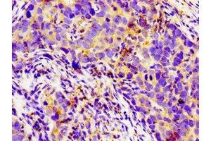 Immunohistochemistry of paraffin-embedded human pancreatic cancer using ABIN7158134 at dilution of 1:100