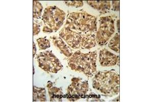 BLNK Antibody (Center) (R) IHC analysis in formalin fixed and paraffin embedded human hepatocarcinoma followed by peroxidase conjugation of the secondary antibody and DAB staining.