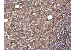 IHC-P Image Albumin antibody detects Albumin protein at cytoplasm in human hepatocellular carcinoma by immunohistochemical analysis. (Albumin anticorps  (C-Term))