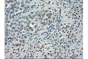Immunohistochemical staining of paraffin-embedded Adenocarcinoma of colon tissue using anti-SATB1mouse monoclonal antibody. (SATB1 anticorps)
