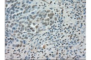 Immunohistochemical staining of paraffin-embedded Adenocarcinoma of colon tissue using anti-SATB1mouse monoclonal antibody.