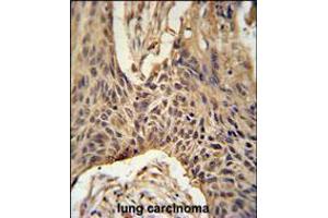 LPPR4 Antibody immunohistochemistry analysis in formalin fixed and paraffin embedded human lung carcinoma followed by peroxidase conjugation of the secondary antibody and DAB staining. (LPPR4 anticorps  (C-Term))