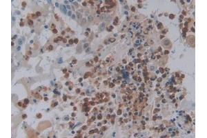 IHC-P analysis of Human Skin cancer Tissue, with DAB staining. (FOS anticorps  (AA 55-298))