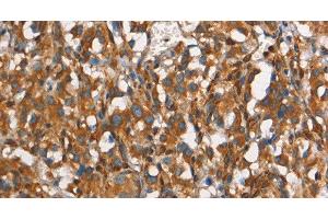 Immunohistochemistry of paraffin-embedded Human thyroid cancer tissue using CEACAM3 Polyclonal Antibody at dilution 1:30 (CEACAM3 anticorps)