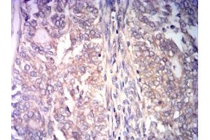 Immunohistochemical analysis of paraffin-embedded cervical cancer tissues using CCNE1 mouse mAb with DAB staining. (Cyclin E1 anticorps  (AA 1-100))