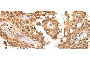 Immunohistochemistry of paraffin-embedded Human ovarian cancer tissue using CLK2 Polyclonal Antibody at dilution of 1:45(x200) (CLK2 anticorps)