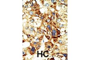 Formalin-fixed and paraffin-embedded human hepatocellular carcinoma tissue reacted with the primary antibody DNMT3A polyclonal antibody  , which was peroxidase-conjugated to the secondary antibody, followed by DAB staining. (DNMT3A anticorps  (Internal Region))