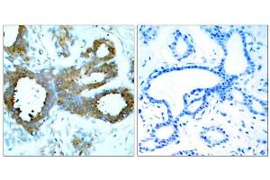 Immunohistochemical analysis of paraffin-embedded human breast carcinoma tissue, using PAK1/PAK2/PAK3 (Phospho-Thr423/Thr402/Thr421) antibody (E011165). (PAK1/2/3 anticorps  (pThr402, pThr421, pThr423))