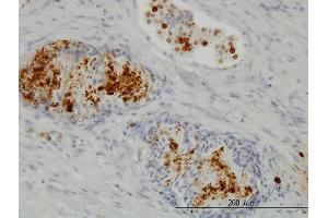 Immunoperoxidase of monoclonal antibody to PIM1 on formalin-fixed paraffin-embedded human prostate. (PIM1 anticorps  (AA 1-313))