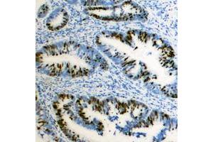 Immunohistochemical analysis of ZEB2 staining in human colon cancer formalin fixed paraffin embedded tissue section.