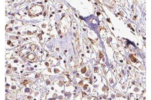ABIN6279467 at 1/100 staining Human breast cancer tissue by IHC-P. (RABIF anticorps  (N-Term))