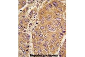 Formalin-fixed and paraffin-embedded human hepatocarcinoma tissue reacted with OA1 antibody (N-term) 7414a , which was peroxidase-conjugated to the secondary antibody, followed by DAB staining. (APOA1 anticorps  (N-Term))