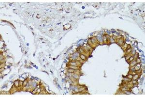 Immunohistochemistry of paraffin-embedded Human mammary cancer using WNT1 Polyclonal Antibody at dilution of 1:100 (40x lens). (WNT1 anticorps)