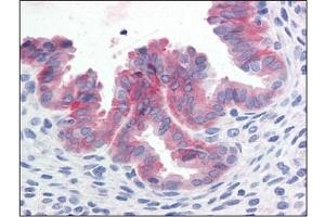 Immunohistochemistry (IHC) image for anti-Met Proto-Oncogene (MET) (Cytoplasmic Domain) antibody (ABIN614469) (c-MET anticorps  (Cytoplasmic Domain))