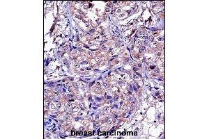 P11 Antibody (C-term) ((ABIN657651 and ABIN2846646))iunohistochemistry analysis in formalin fixed and paraffin embedded human breast carcinoma followed by peroxidase conjugation of the secondary antibody and DAB staining.
