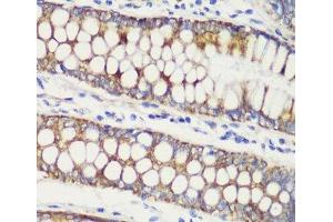 Immunohistochemistry of paraffin-embedded Human colon carcinoma using TOM20 Polyclonal Antibody at dilution of 1:100 (40x lens). (TOMM20 anticorps)