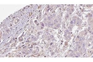 ABIN6273928 at 1/100 staining Human liver cancer tissue by IHC-P. (GPR161 anticorps  (Internal Region))