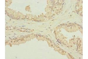 Immunohistochemistry of paraffin-embedded human prostate cancer using ABIN7168604 at dilution of 1:100 (SCAND1 anticorps  (AA 1-179))