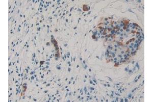 DAB staining on IHC-P; Samples: Human Pancreatic cancer Tissue (THBS3 anticorps  (AA 670-921))
