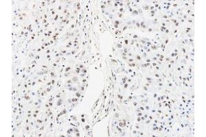 IHC-P Image Immunohistochemical analysis of paraffin-embedded A549 xenograft, using HNRNPAB, antibody at 1:100 dilution.