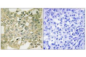 Immunohistochemistry analysis of paraffin-embedded human breast carcinoma tissue using MYT1 (Phospho-Ser83) antibody. (MYT1 anticorps  (pSer83))