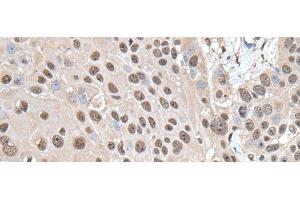 Immunohistochemistry of paraffin-embedded Human esophagus cancer tissue using SMC1A Polyclonal Antibody at dilution of 1:30(x200)