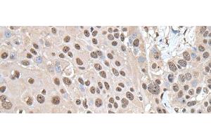 Immunohistochemistry of paraffin-embedded Human esophagus cancer tissue using SMC1A Polyclonal Antibody at dilution of 1:30(x200) (SMC1A anticorps)