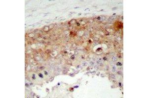 Immunohistochemical analysis of SHCA (pY427) staining in human prostate cancer formalin fixed paraffin embedded tissue section. (SHC1 anticorps  (pTyr427))