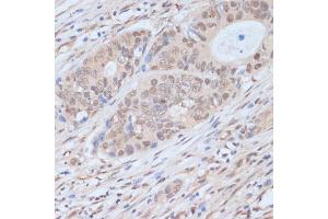 Immunohistochemistry of paraffin-embedded human colon carcinoma using CDK9 antibody (ABIN6129241, ABIN6138331, ABIN6138332 and ABIN6214015) at dilution of 1:100 (40x lens). (CDK9 anticorps  (AA 153-372))