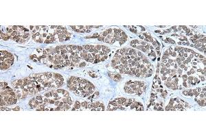 Immunohistochemistry of paraffin-embedded Human esophagus cancer tissue using RPF2 Polyclonal Antibody at dilution of 1:40(x200) (RPF2 anticorps)
