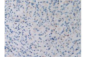 IHC-P analysis of Human Prostate Gland Cancer Tissue, with DAB staining. (DDX58 anticorps  (AA 550-776))