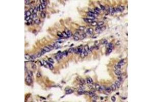 Formalin-fixed and paraffin-embedded human lung carcinoma tissue reacted with MAPK1 Antibody (Center) , which was peroxidase-conjugated to the secondary antibody, followed by DAB staining. (ERK2 anticorps  (Middle Region))