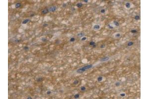 IHC-P analysis of Human Glioma Tissue, with DAB staining. (Aquaporin 4 anticorps  (AA 178-317))