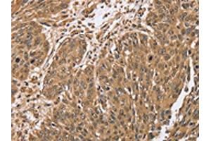 The image on the left is immunohistochemistry of paraffin-embedded Human lung cancer tissue using ABIN7192064(PTPN20A/PTPN20B Antibody) at dilution 1/40, on the right is treated with synthetic peptide. (PTPN2 anticorps)