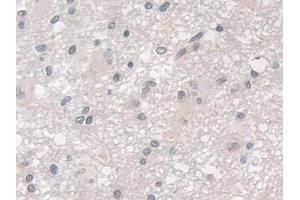 Detection of GPX3 in Human Glioma Tissue using Polyclonal Antibody to Glutathione Peroxidase 3, Plasma (GPX3)