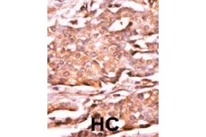 Formalin-fixed and paraffin-embedded human hepatocellular carcinoma tissue reacted with RAD9A (phospho S272) polyclonal antibody  which was peroxidase-conjugated to the secondary antibody followed by AEC staining. (RAD9A anticorps  (pSer272))